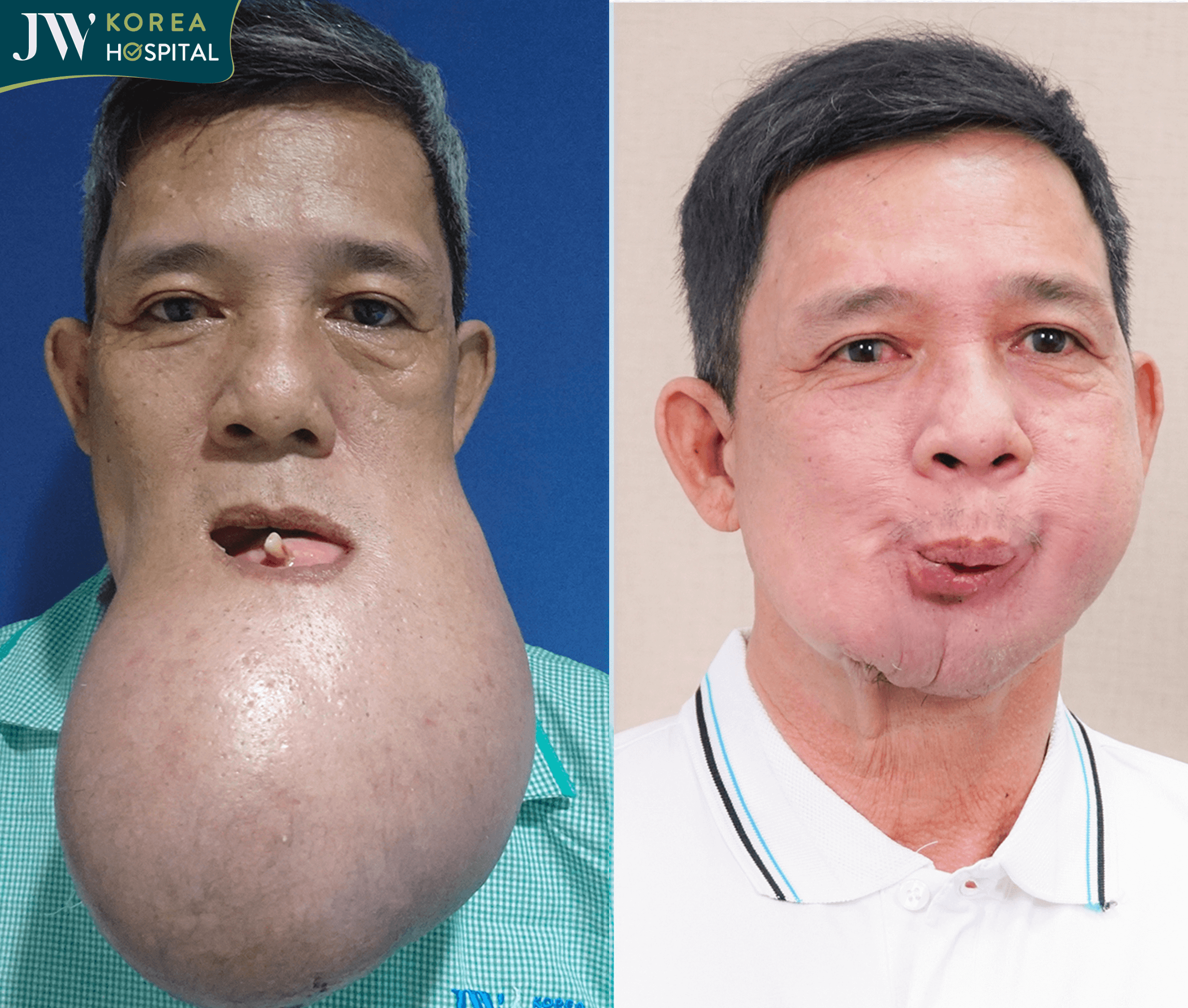 Hình ảnh trước và sau của chú Khanh đến bệnh viện JW