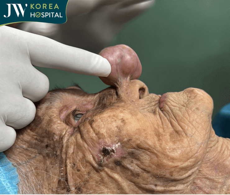 cu ba chuan bi phau thuat khoi u