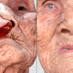 Bệnh viện JW báo tin vui về cụ bà 100 tuổi sau ca mổ cắt khối bướu quỷ