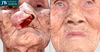 Bệnh viện JW báo tin vui về cụ bà 100 tuổi sau ca mổ cắt khối bướu quỷ