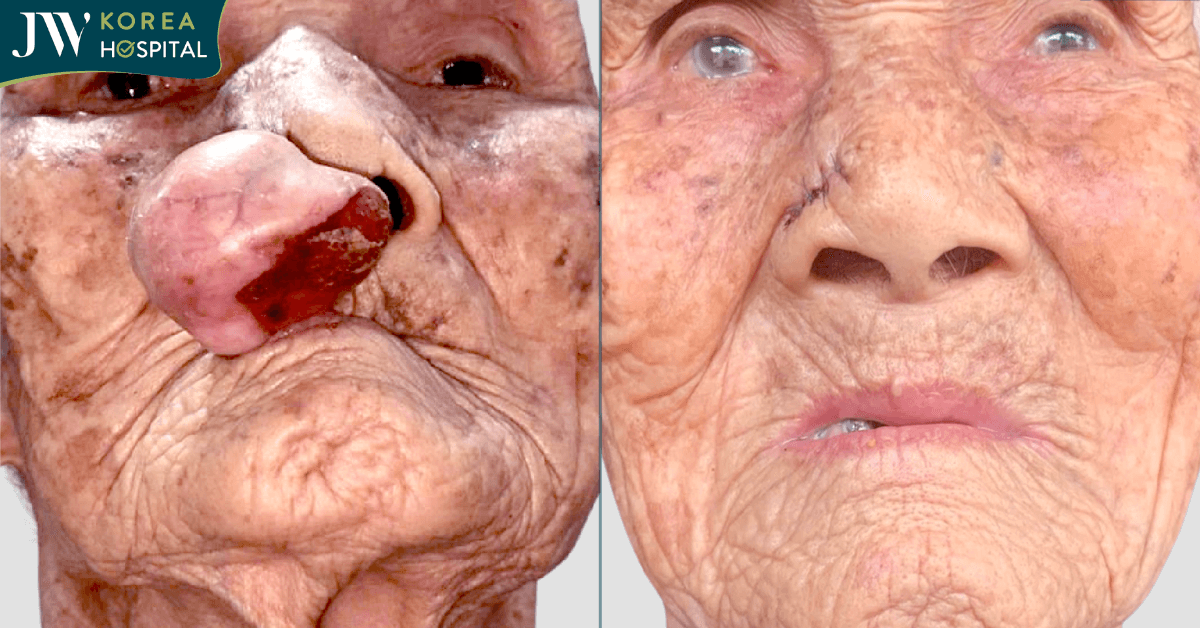 diện mạo mới sau khi phẫu thuật cắt khối u của cụ