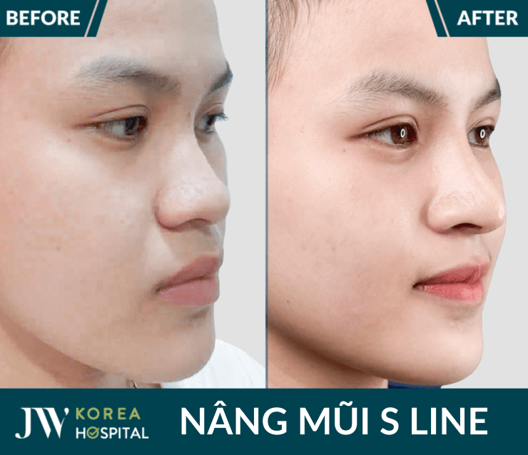 Nang mui tai JW giup guong mat rang ro hon nho dang mui cao chuan Han