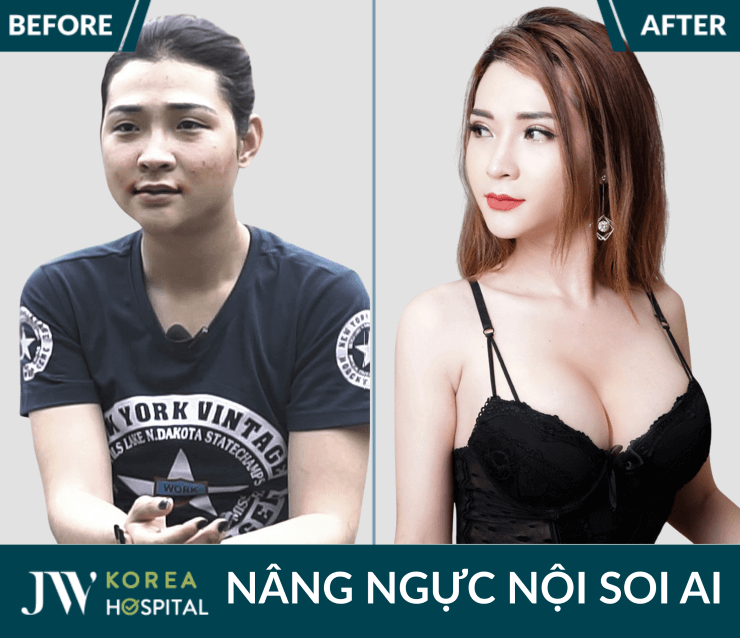 quy trinh nang nguc noi soi ai an toan