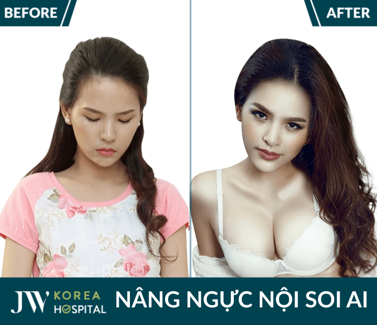 quy trinh nang nguc noi soi ai an toan chuan han