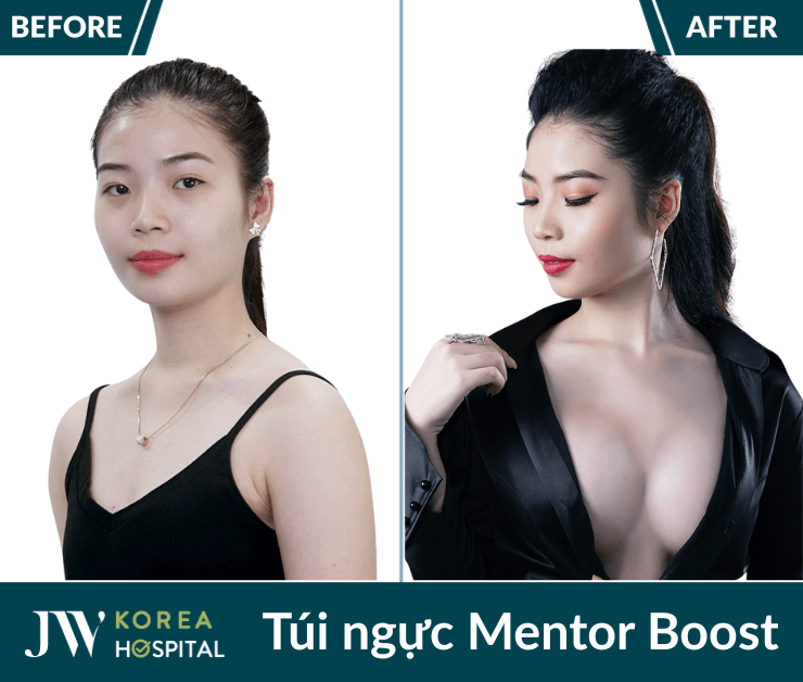 nâng ngực túi ngực mentor boost