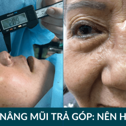 Nâng mũi trả góp: Có nên lựa chọn? Giải pháp an toàn tại Bệnh viện JW Hàn Quốc