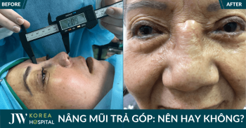 Nâng mũi trả góp: Có nên lựa chọn? Giải pháp an toàn tại Bệnh viện JW Hàn Quốc