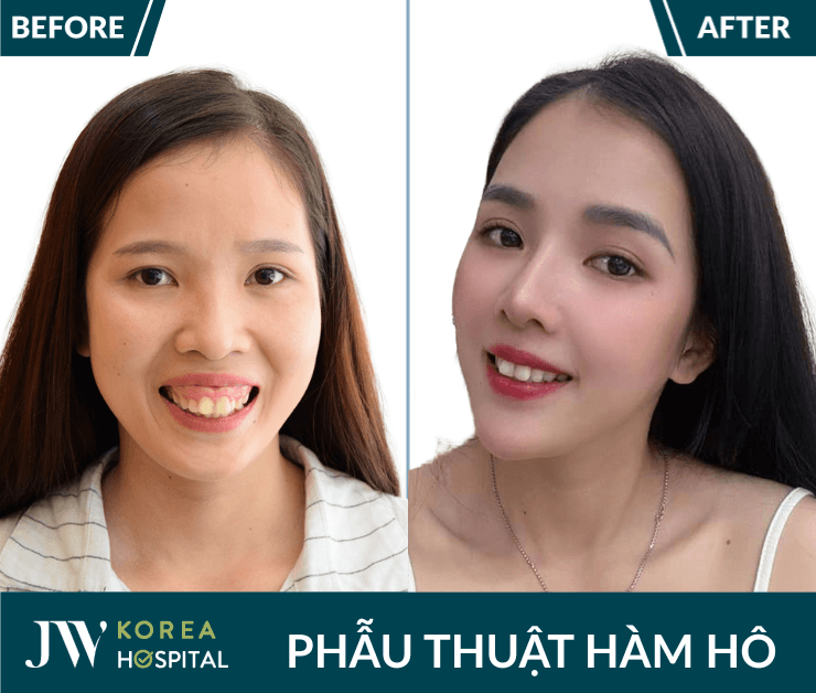 phẫu thuật hàm hô tại jw