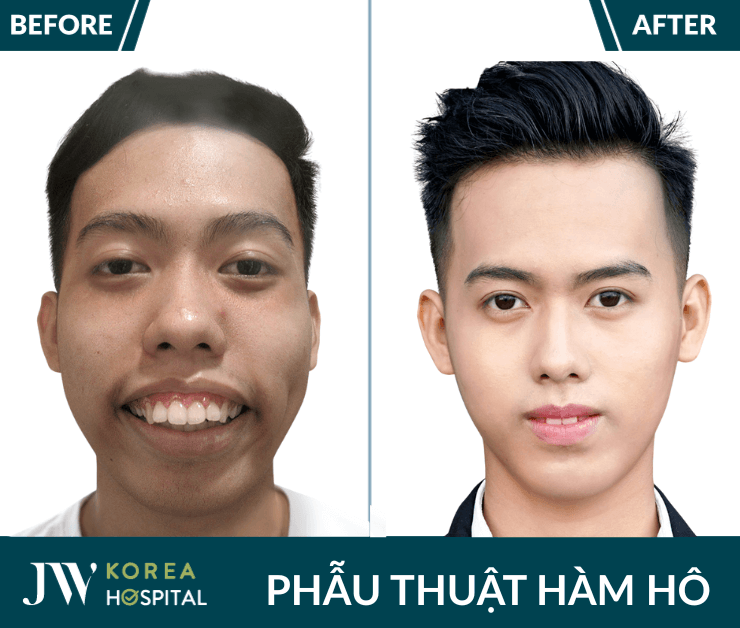 phẫu thuật hàm hô tại jw