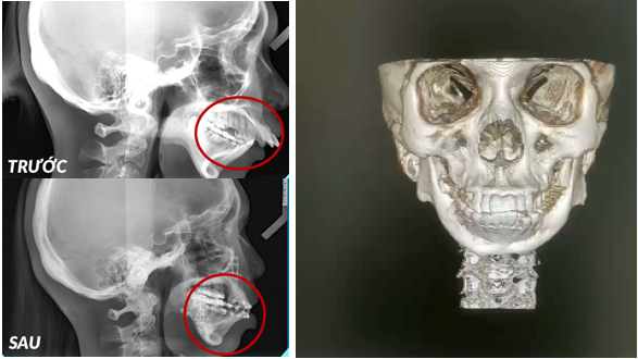 phẫu thuật hàm hô tại hội nghị HPASS 2025