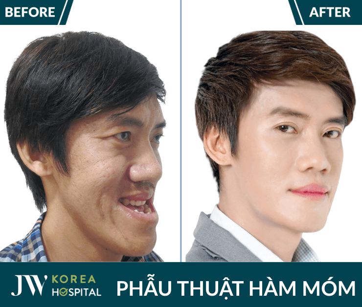 phẫu thuật hàm móm tại jw
