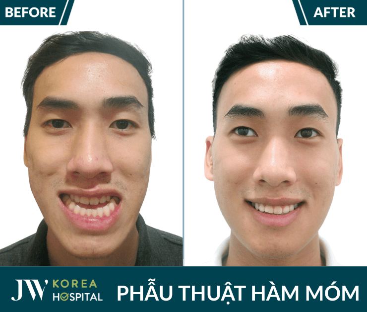 phẫu thuật hàm móm tại jw