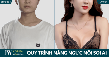 Quy trình nâng ngực nội soi AI chuẩn Hàn tại JW – Bí quyết an toàn để sở hữu vòng 1 quyến rũ