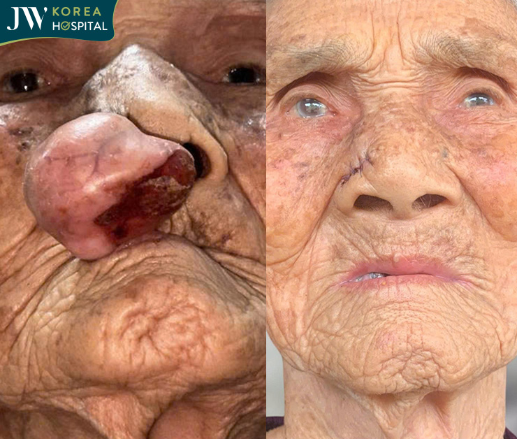 Hình ảnh của cụ Khoan 100 tuổi trước và sau khi cắt bỏ khối bướu quỷ tại Bệnh viện JW