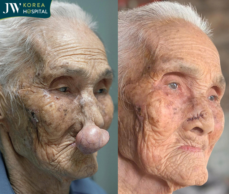 Hình ảnh của cụ Khoan 100 tuổi trước và sau khi đến Bệnh viện JW