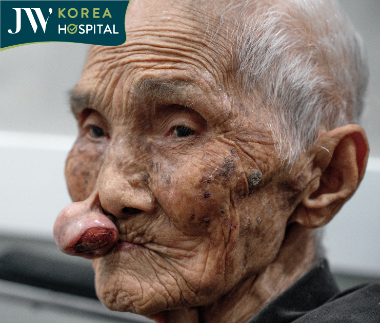 Hình ảnh đầy tội nghiệp của cụ bà 100 tuổi sống với khối u mạch máu chèn ép đường thở suốt hơn 30 năm