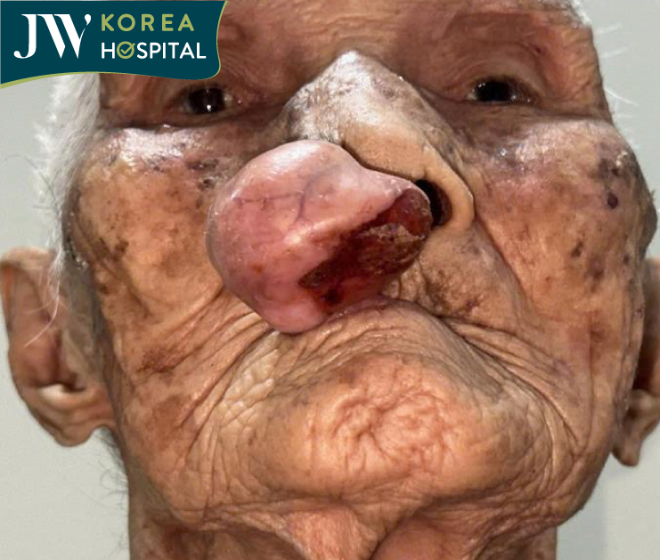 Cụ bà 100 tuổi với khối u mạch máu suốt hơn 30 năm