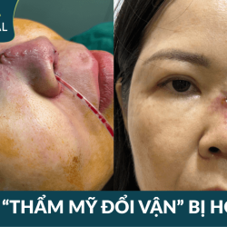 Đi xăm chỉ tay 200 nghìn, bị thầy phong thủy Thái Lan lừa thẩm mỹ đổi vận 65 triệu khiến mũi bị cháy xém 
