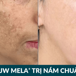 Trị nám JW MELA+ Giải pháp chuẩn y khoa giúp cải thiện nám, dưỡng sáng da