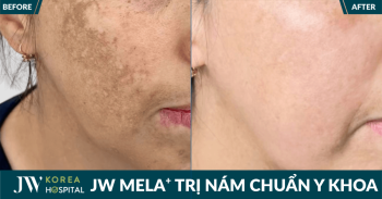 Trị nám JW MELA+ Giải pháp chuẩn y khoa giúp cải thiện nám, dưỡng sáng da