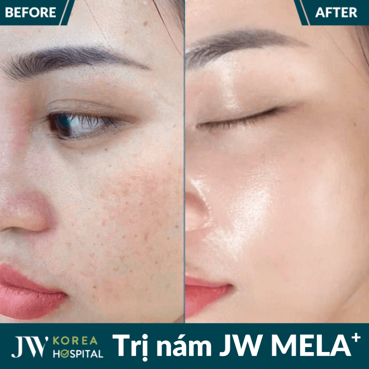 Liệu trình trị nám JW MELA+ tại Bệnh viện JW Hàn Quốc 
