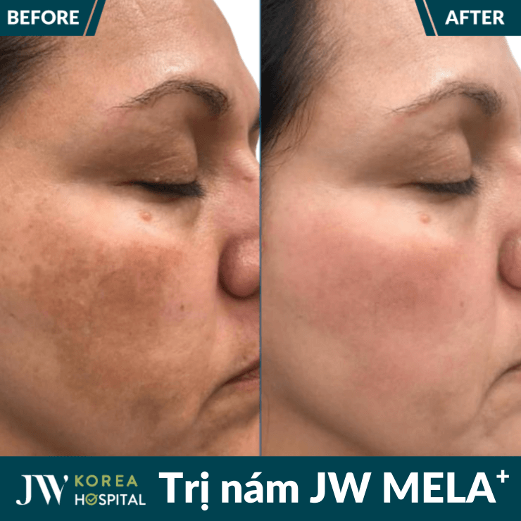 Liệu trình điều trị nám JW MELA+ 