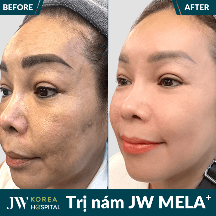 Liệu trình điều trị nám JW MELA+ tại JW