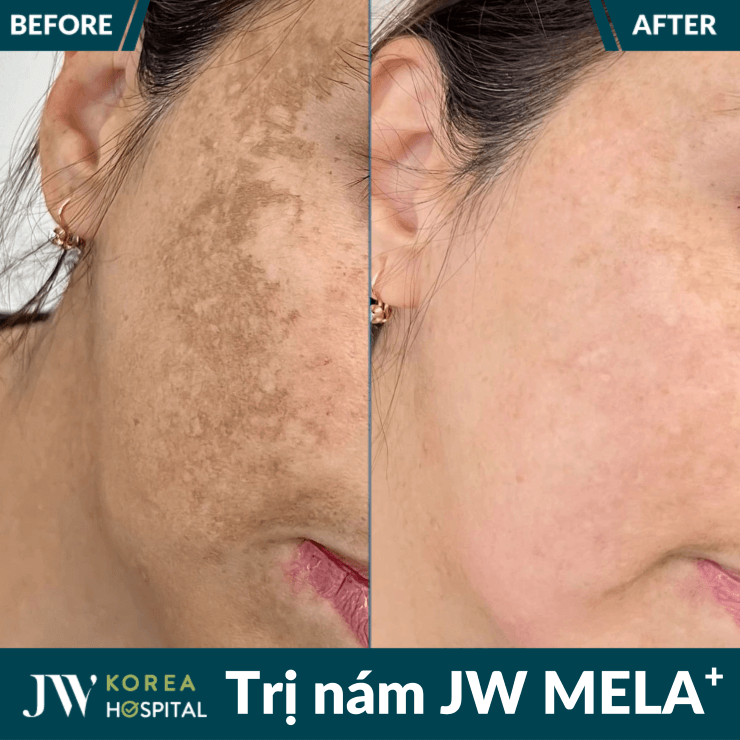 Liệu trình điều trị nám JW MELA+ tại Bệnh viện JW 