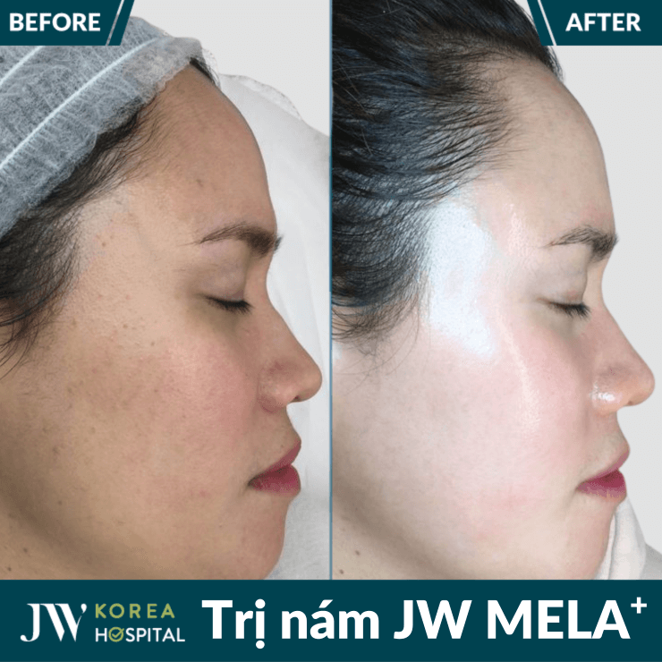 Liệu trình điều trị nám JW MELA+ tại Bệnh viện JW Hàn Quốc 