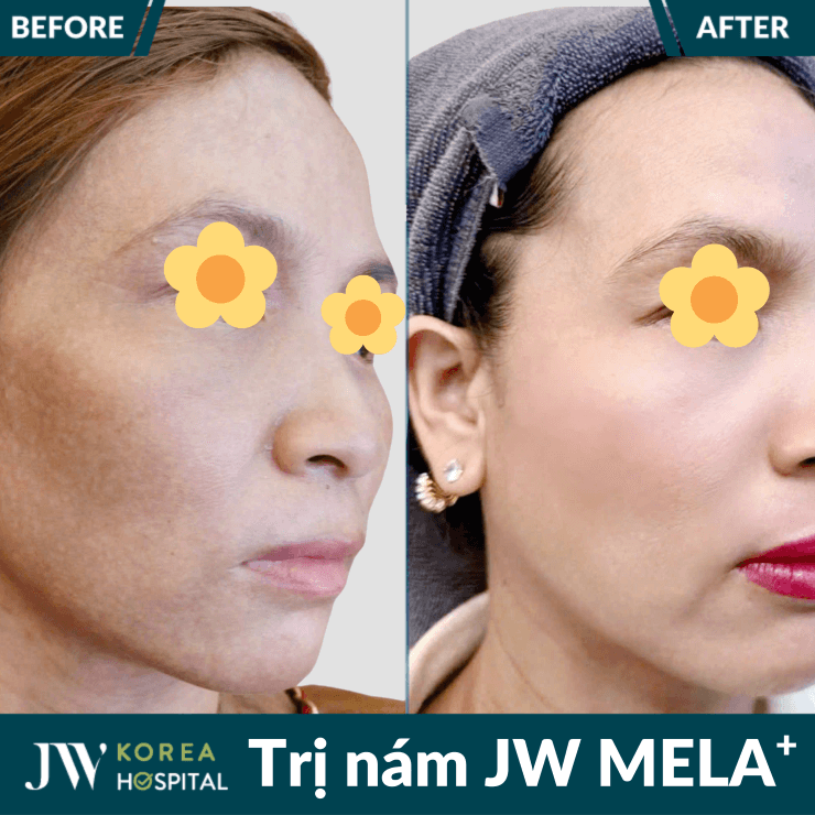 Hiệu quả vượt trội sau liệu trình điều trị nám tại Bệnh viện JW 