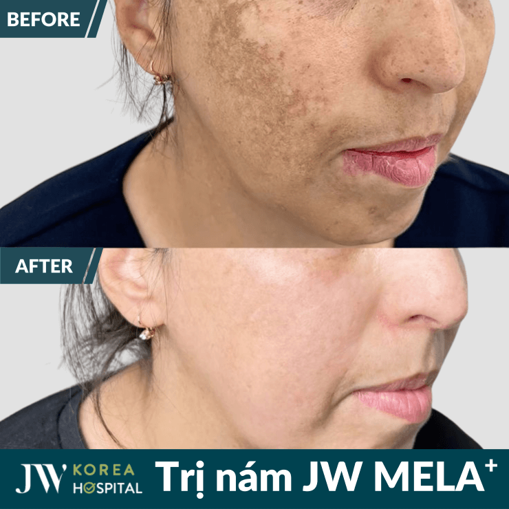 Da sáng mịn, xóa nám sau liệu trình điều trị nám tại Bệnh viện JW Hàn Quốc 