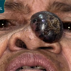 Xót Xa Sư Bà Khơ-me 80 Tuổi Mang Khối U Tím Hoại Tử: Bác Sĩ Tú Dung Phẫu Thuật Miễn Phí Cứu Sống Hơi Thở Cuối Đời