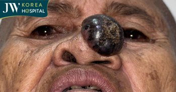 Xót Xa Sư Bà Khơ-me 80 Tuổi Mang Khối U Tím Hoại Tử: Bác Sĩ Tú Dung Phẫu Thuật Miễn Phí Cứu Sống Hơi Thở Cuối Đời