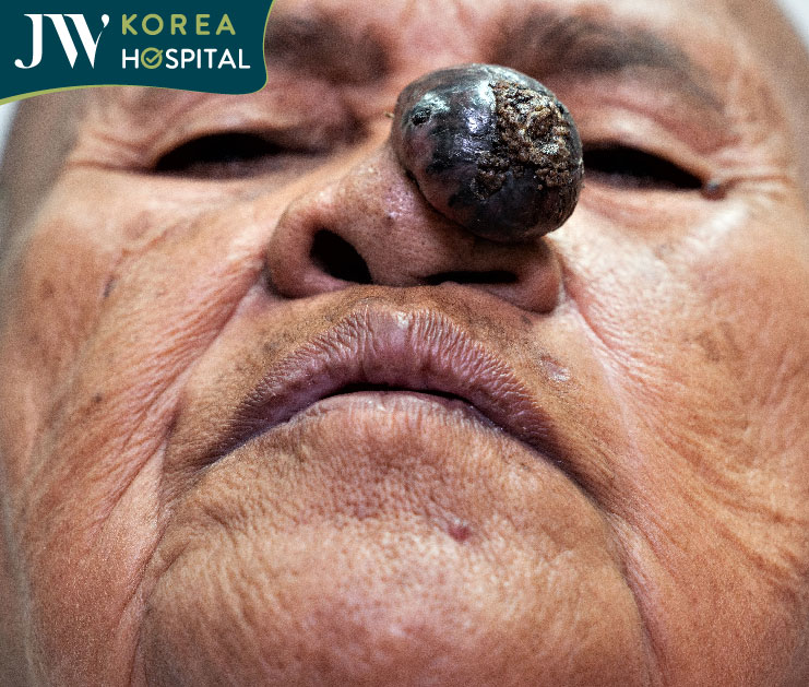 Sư bà Khơ-me sống chung với khối u suốt 2 năm liền