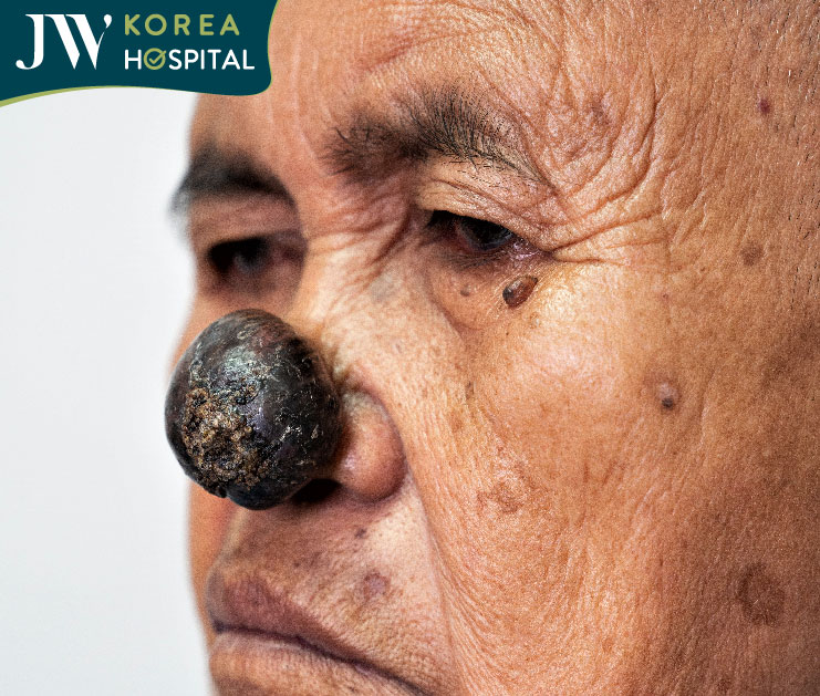 Sư bà khơ-me bị khối u hoại tử trên mặt 2 năm