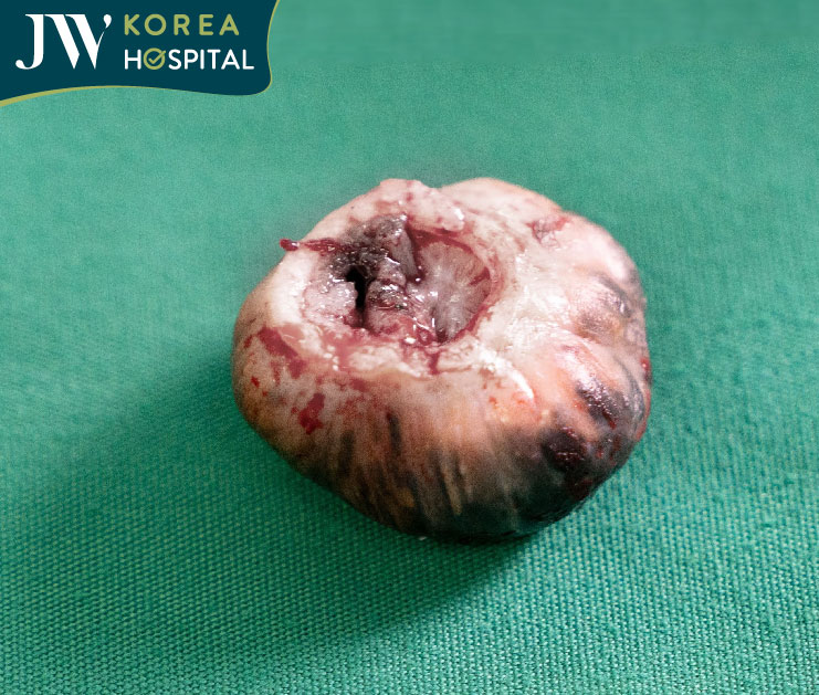 Khối u hoại tử chèn ép đường thở của sư bà Khơ-me 2 năm