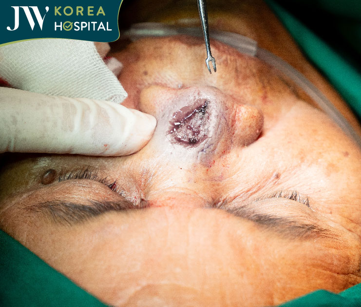 Hình ảnh sư bà Khơ-me sau khi cắt bỏ u thành công