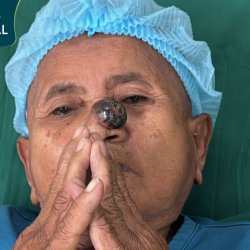 Sư bà Khơ-me 80 tuổi được bác sĩ Tú Dung cứu sống khỏi khối u ác tính ở mũi