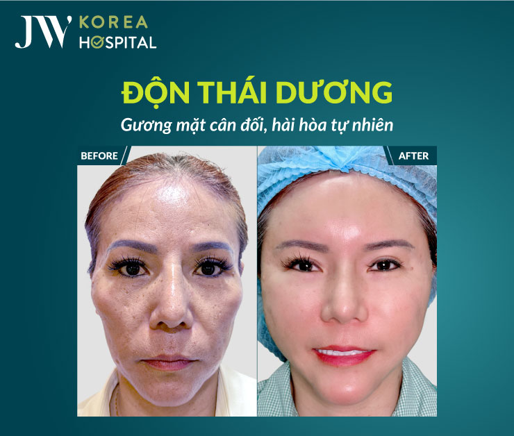 Độn thái dương là gì? Ai nên chọn độn thái dương