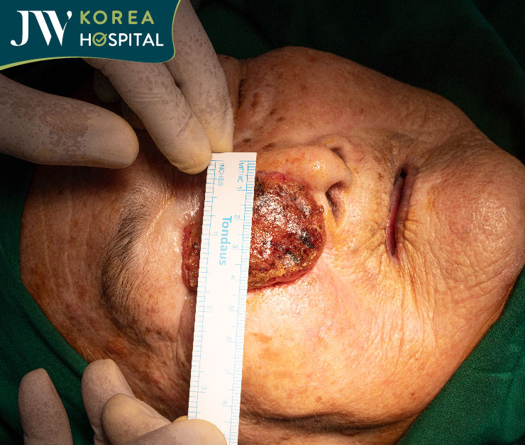 bác sĩ Tú Dung quyết định phẫu thuật cắt u hoại tử trên mặt cho cụ bà 93 tuổi