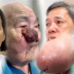 Phẫu thuật u bướu miễn phí: 10 năm vì bệnh nhân nghèo tại JW