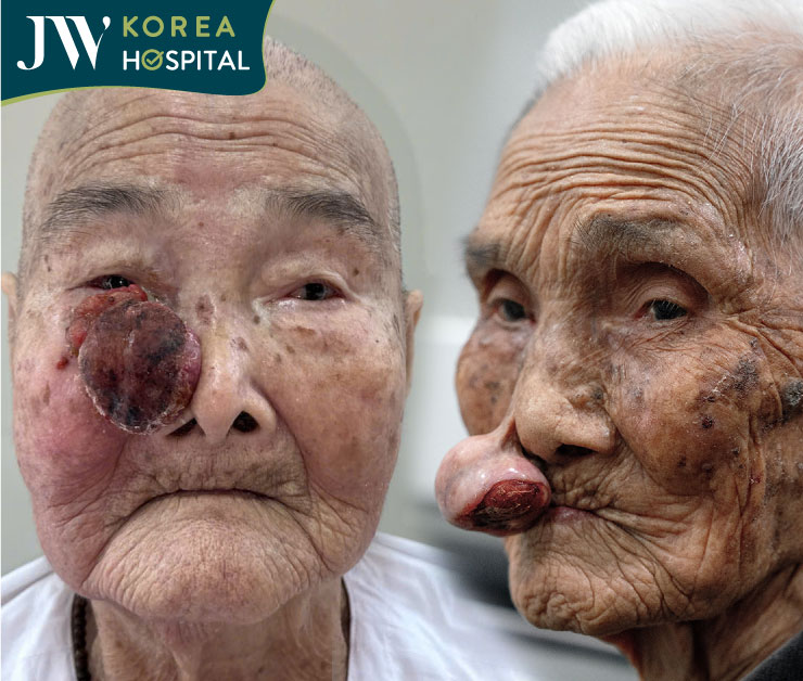 Bệnh viện JW đã tiếp nhận và điều trị thành công cho nhiều bệnh nhân bị khối u