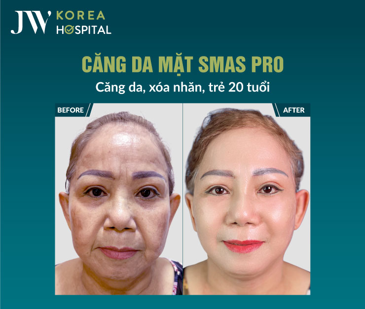 Căng da mặt SMAS Pro tại Bệnh viện JW giúp làn da săn chắc, giảm nếp nhăn hiệu quả
