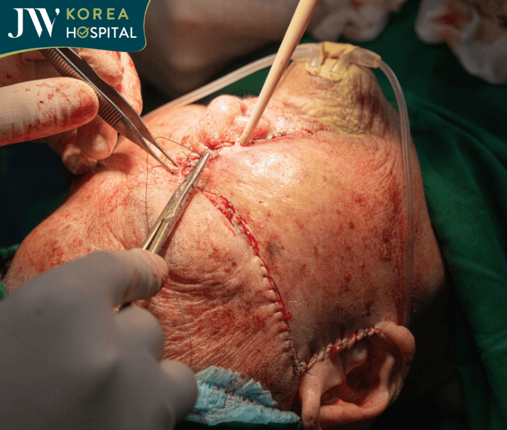 cat bo hoan toan khoi u cho cu