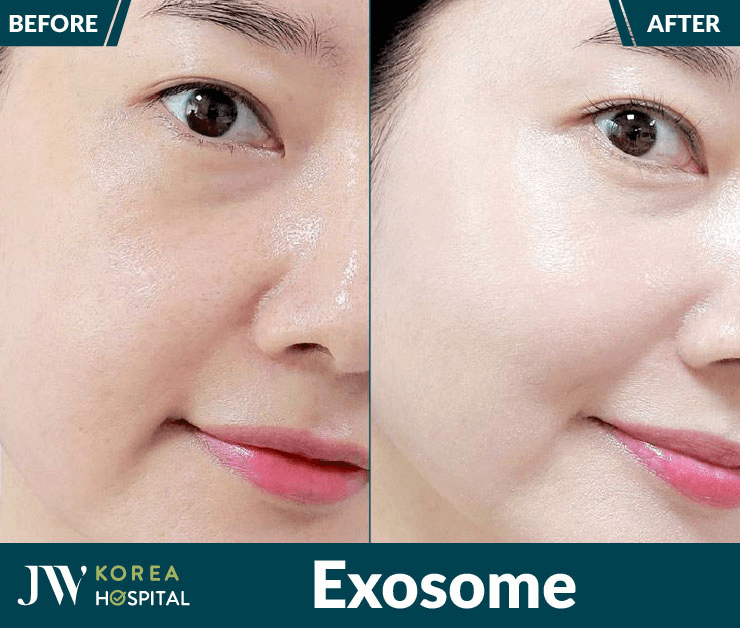 công nghệ trẻ hóa exosome là gì? Công dụng như thế nào?