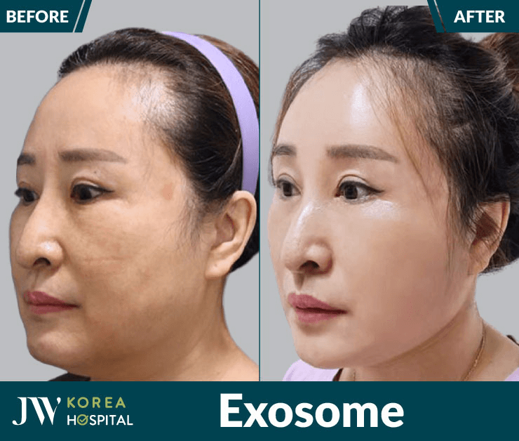 Công dụng của công nghệ trẻ hóa Exosome tại Bệnh viện JW