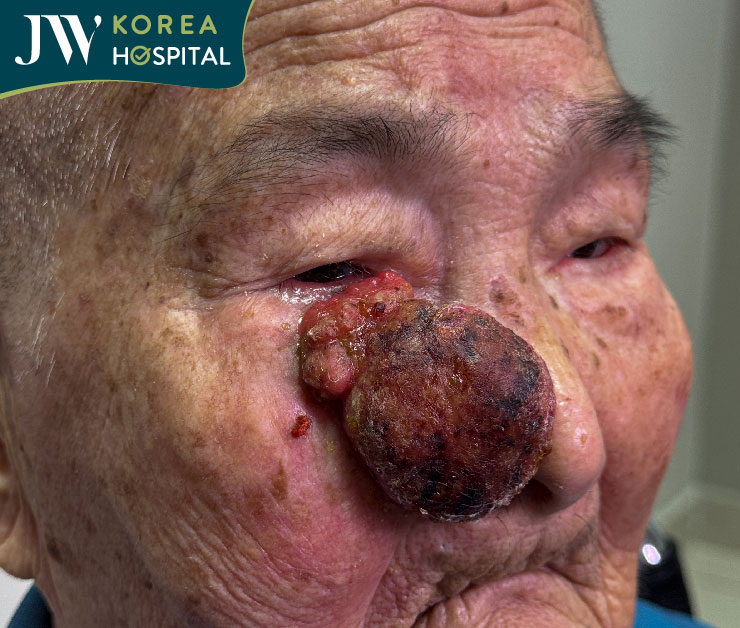 Cụ bà 93 tuổi sống trong đau đớn bị khối u hoại tử sát mắt chảy máu và lở loét được bác sĩ Tú Dung cứu chữa