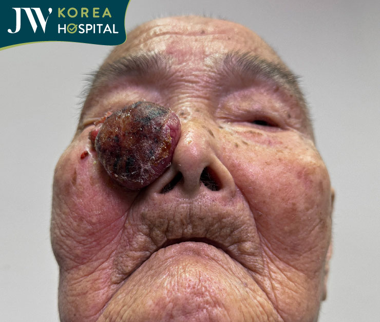 Khối u hoại tử sát mắt khiến cụ bà 93 tuổi bị giảm thị lực và gây khó khăn trong sinh hoạt hằng ngày