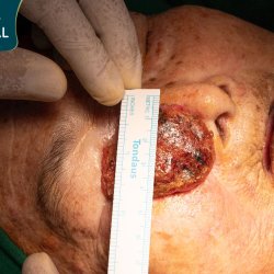 Bệnh viện JW phẫu thuật thành công cắt khối u vùng mặt cho cụ bà 93 tuổi suy tim nặng