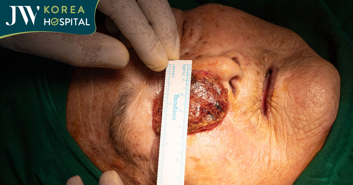 Khối u có kích thước lớn nằm sát mắt của cụ bà 93 tuổi được bác sĩ Tú Dung cứu giúp